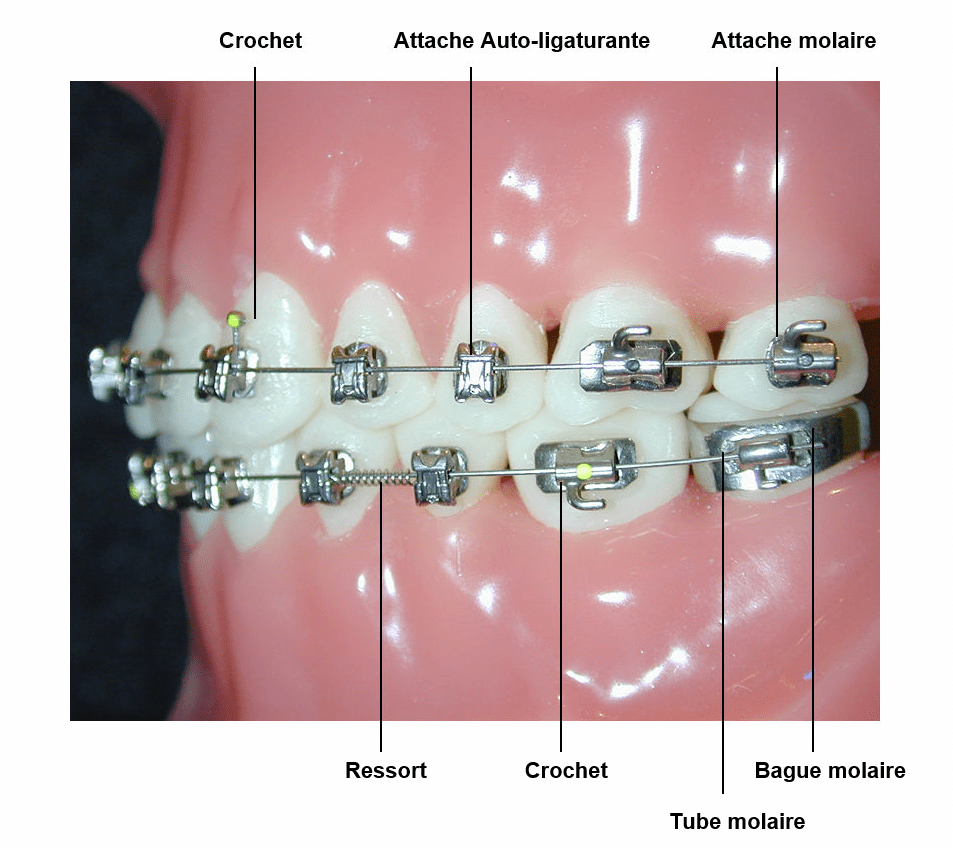 Tube croisé à sertir orthodontique dentaire, double tube pour fils