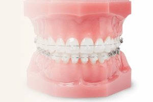 Systeme autoligaturant Orthodontiste Molsheim Dr Robert