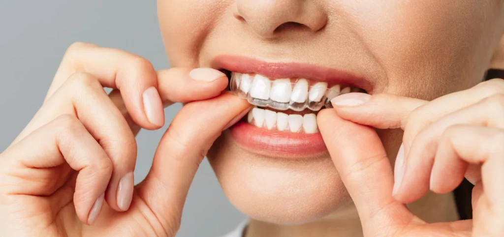 gouttiere invisible orthodontiste molsheim gouttiere invisible orthodontiste molsheim Le système invisible Dr Vincent Robert | Orthodontiste à Molsheim