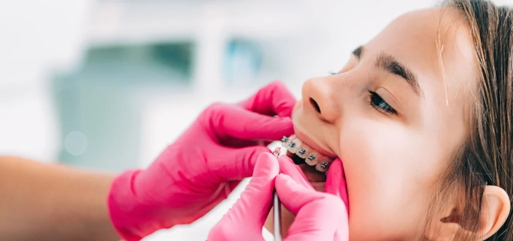 orthodontie adolescent multi attaches orthodontiste molsheim orthodontie adolescent multi attaches orthodontiste molsheim Quand consulter un orthodontiste ? Dr Vincent Robert | Orthodontiste à Molsheim