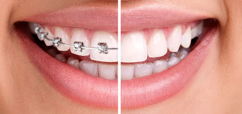 orthodontie docteur vincent robert orthodontie docteur vincent robert Traitement orthodontique Dr Vincent Robert | Orthodontiste à Molsheim