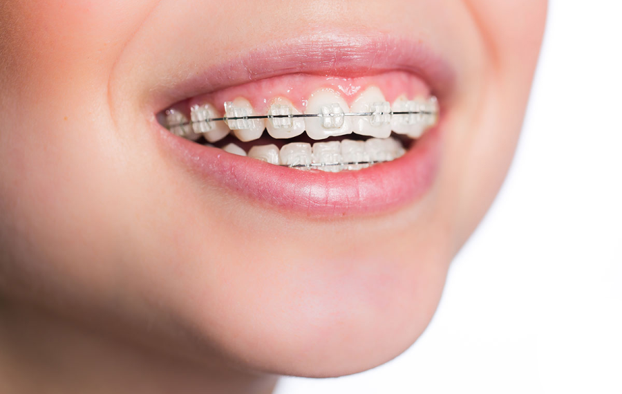 Système multi attaches autoligaturant céramique molsheim