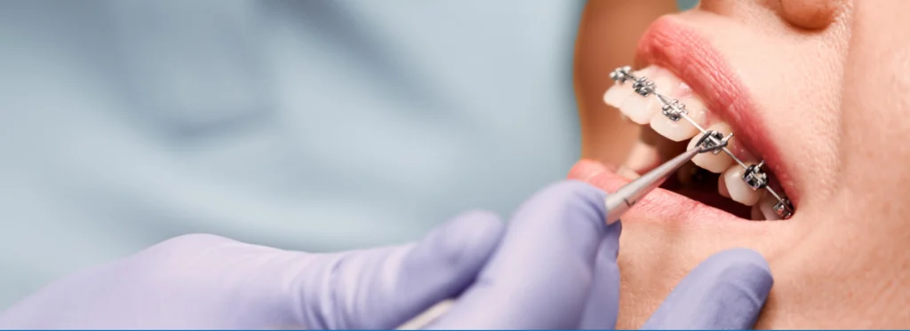 Système multi attaches autoligaturant dr robert