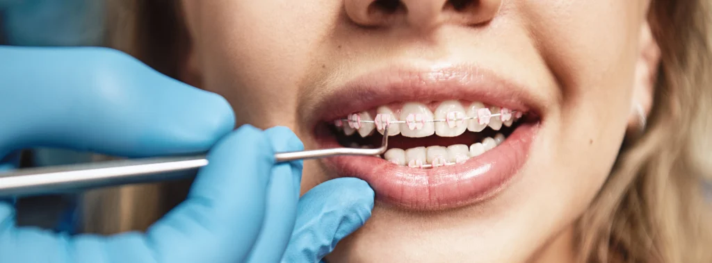 alimentation appareil dentaire schirmeck alimentation appareil dentaire schirmeck Orthodontiste près d'Entzheim : aligneurs transparents et appareil multi-attaches au cabinet du Dr Vincent Robert Dr Vincent Robert | Orthodontiste à Molsheim