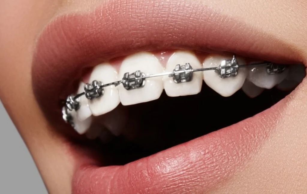 appareil dentaire molsheim fixe appareil dentaire molsheim fixe Orthodontiste près de Barr : aligneurs transparents et appareil multi-attaches au cabinet du Dr Robert Dr Vincent Robert | Orthodontiste à Molsheim