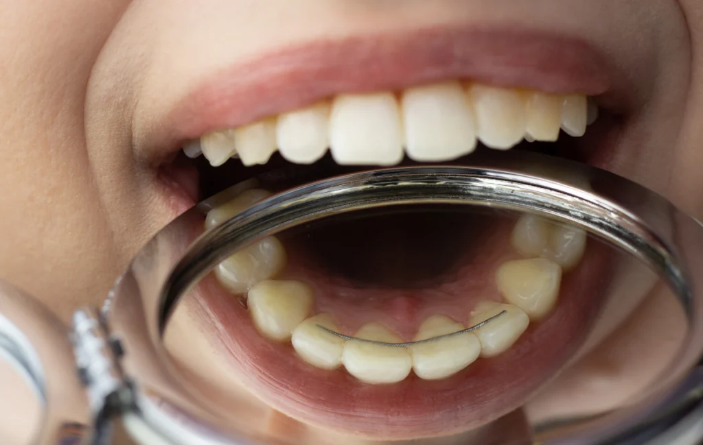 contention dentaire mutzig traitement contention dentaire mutzig traitement Orthodontiste près de Schirmeck : redresser les dents avec aligneurs ou appareil multi-attaches Dr Vincent Robert | Orthodontiste à Molsheim