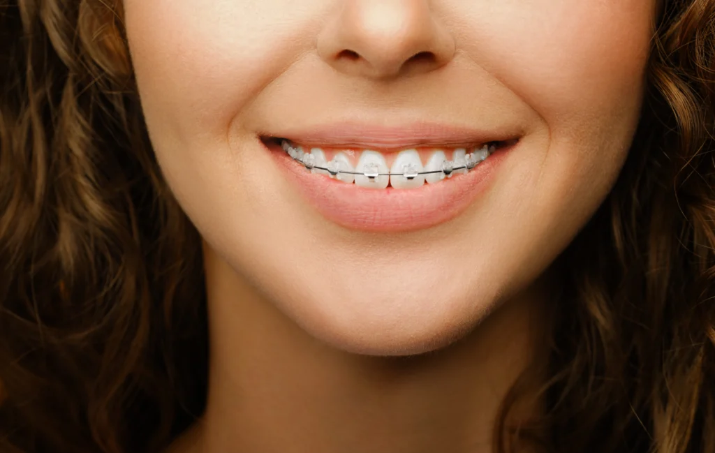 multi bagues adultes molsheim multi bagues adultes molsheim Orthodontiste près de Schirmeck : redresser les dents avec aligneurs ou appareil multi-attaches Dr Vincent Robert | Orthodontiste à Molsheim